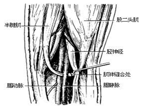 【病因】原发性下肢深静脉瓣膜关闭不全的病因(图1) 【病因】原发性下肢深静脉瓣膜关闭不全的病因(图1)